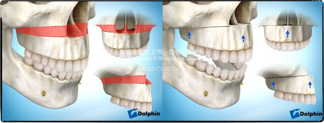 笑齦-長臉-正顎手術