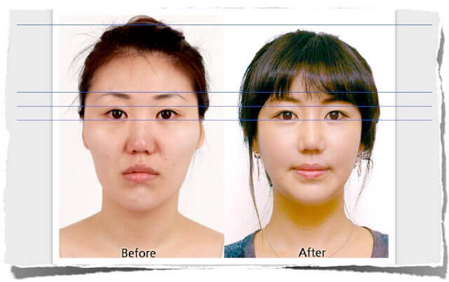 長臉分析-正顎手術