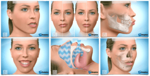 正顎手術治療對象