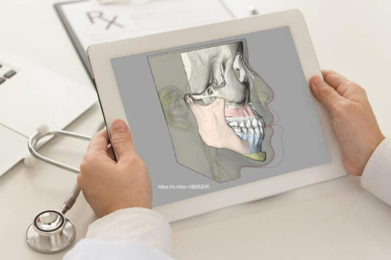 正顎手術-3D電腦輔助手術模擬
