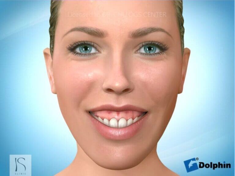 正顎手術-笑齦