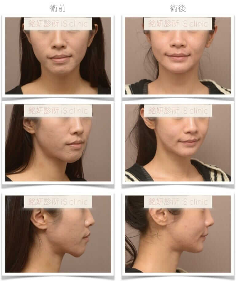 臉不對稱-進階手術優先-正顎手術-術前術後