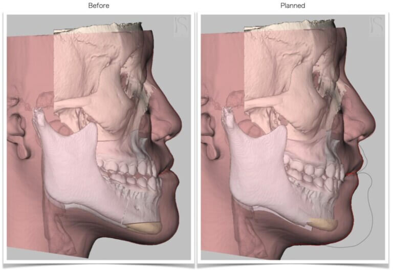 戽斗-暴牙-3D正顎手術模擬-正顎手術