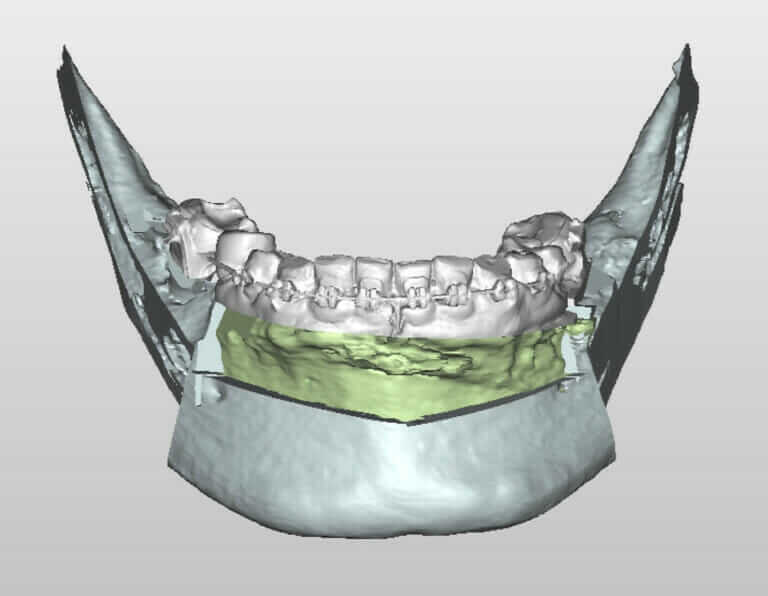 下顎前牙根尖下截骨術-Anterior-subapical-osteotomy-of-the-mandible