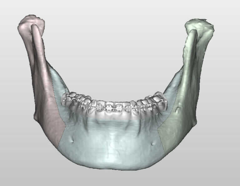 下顎雙側升枝矢狀截骨術-Bilateral-sagittal-split-ramus-osteotomy-BSSO