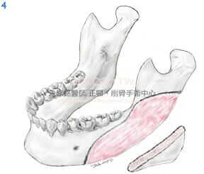 下顎骨角-下顎骨削骨手術4