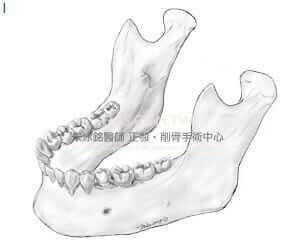 下顎骨角-下顎骨削骨手術1