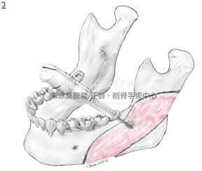 下顎骨角-下顎骨削骨手術2