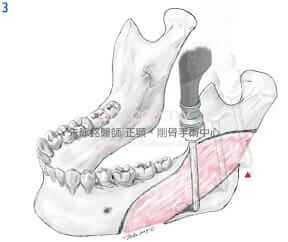 下顎骨角-下顎骨削骨手術3