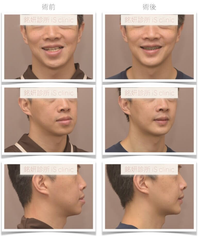 不典型戽斗-臉不對稱-進階手術優先-正顎手術-術前術後