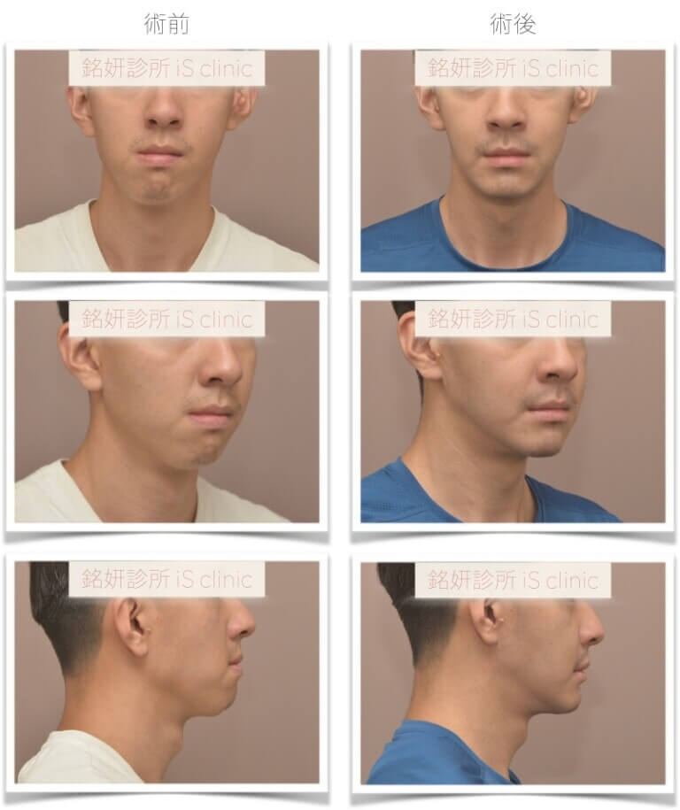 不典型戽斗-臉不對稱-進階手術優先-正顎手術-術前術後