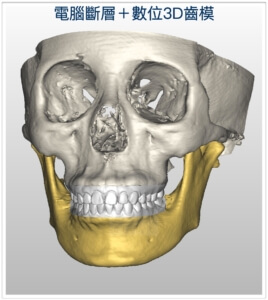 3D模擬手術模型-3D正顎手術