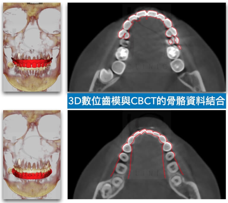 3D正顎手術-牙模臉骨結合
