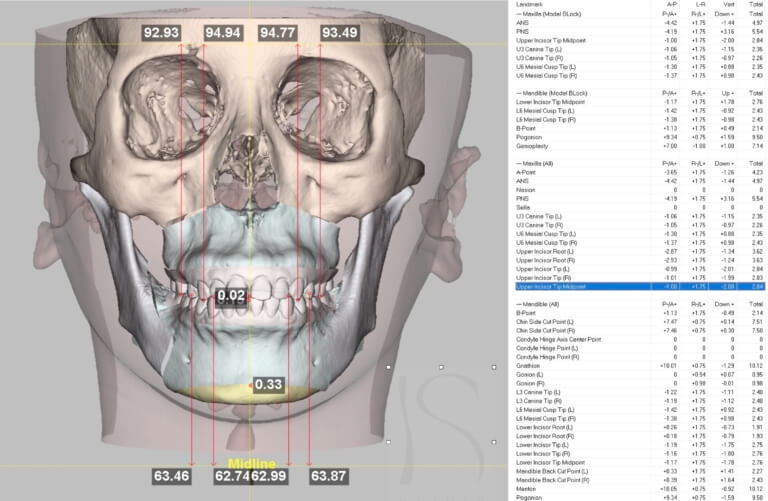 3D正顎手術計畫1