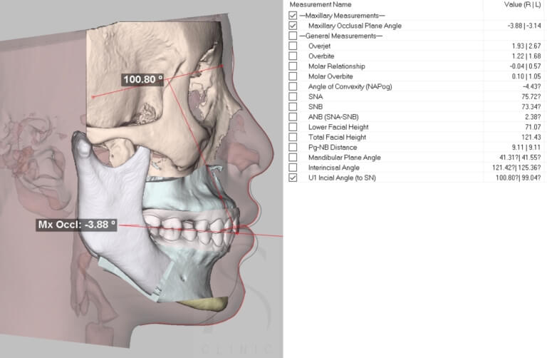 3D正顎手術計畫2