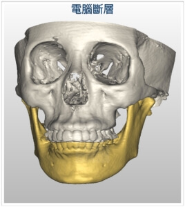 3D電腦斷層-3D正顎手術