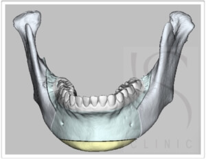下顎升枝矢狀截骨術-下巴截骨術-3D正顎手術
