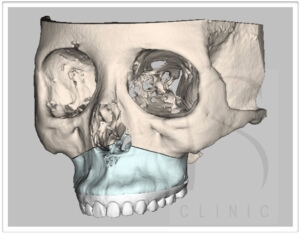 勒福氏第一型上顎截骨術-3D正顎手術