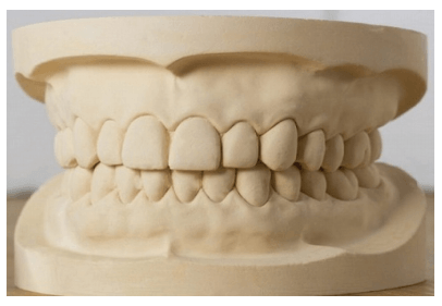 牙齒石膏模型